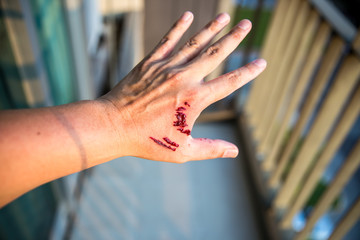 hand with animal bite